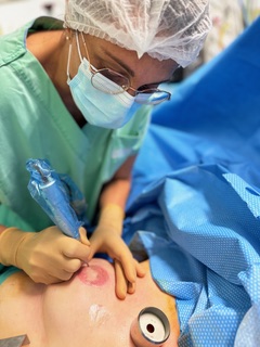 Reconstruction de l’aréole par dermopigmentation - résultat final