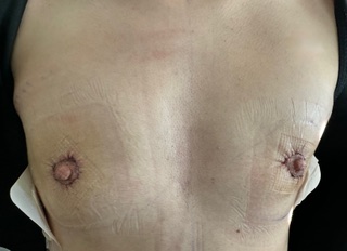 Illustration de la chirurgie mammaire transgenre – mastectomie périaréolaire après